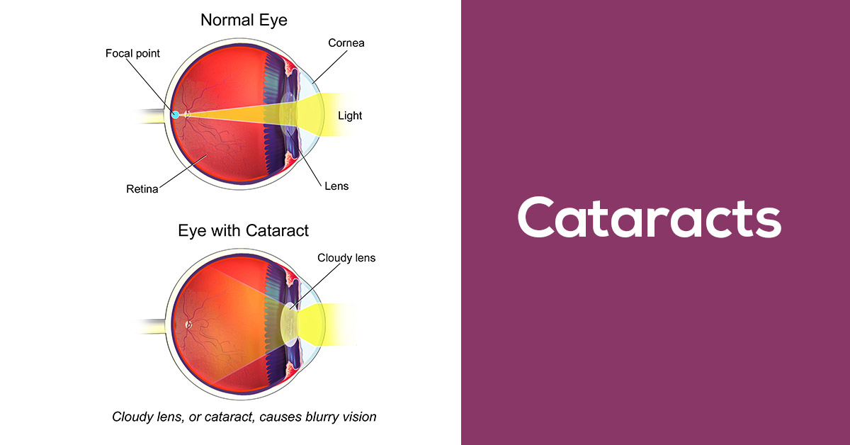 Premier Medical cataract correction