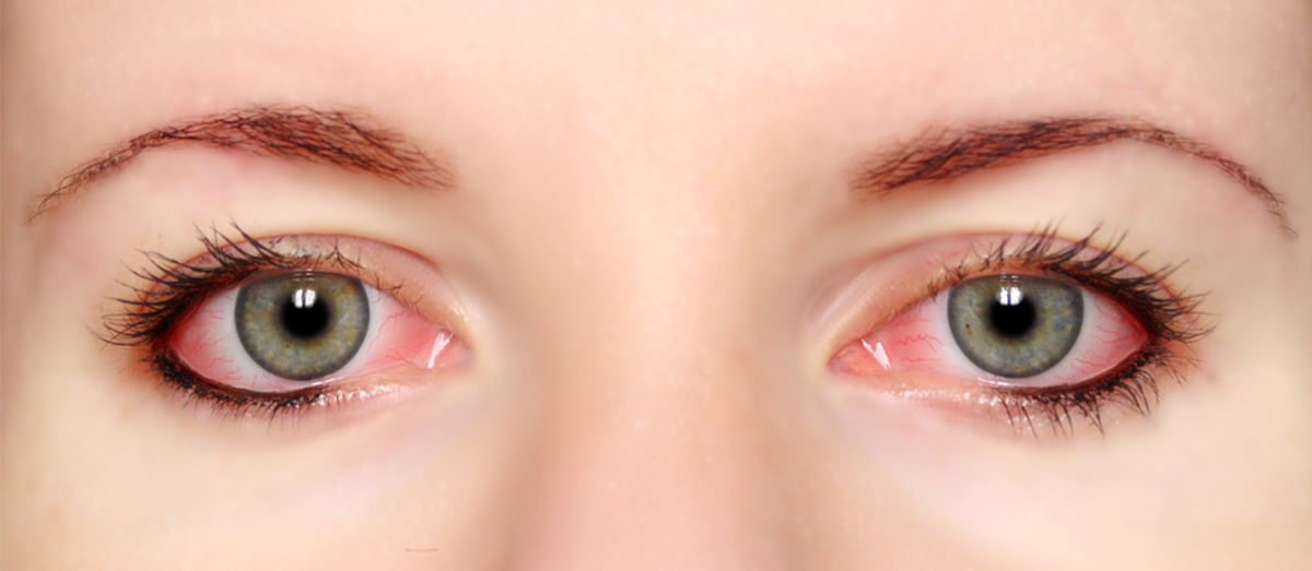 photo of woman's irritated, red eyes