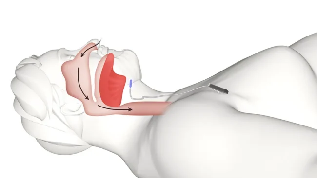 diagram of person's airways during sleep